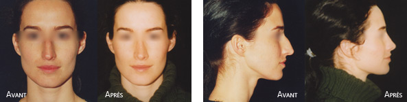 chirurgie esthétique et reconstructrice du nez