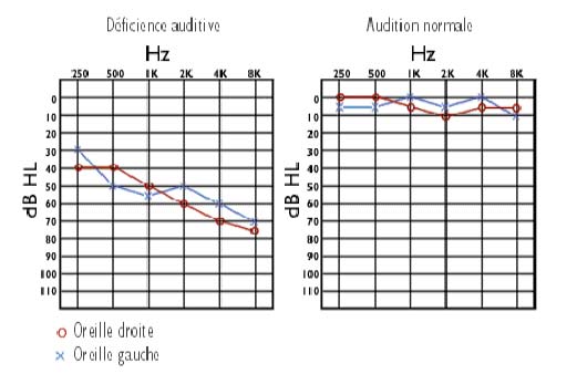 Audiogramme Tonal