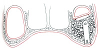 préimplantaire dentaire et rhinoplastie