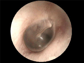 Pathologie de l'Oreille / Activité ORL Chirurgicale / ORL de A à Z ...