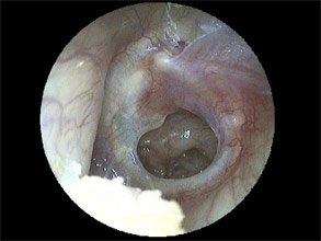 Pathologie de l'Oreille / Activité ORL Chirurgicale / ORL de A à Z ...