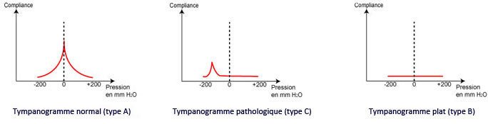 Impedancemetrie et pathologie de l'oreille